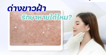 ด่างขาวฝ้า melasma laser