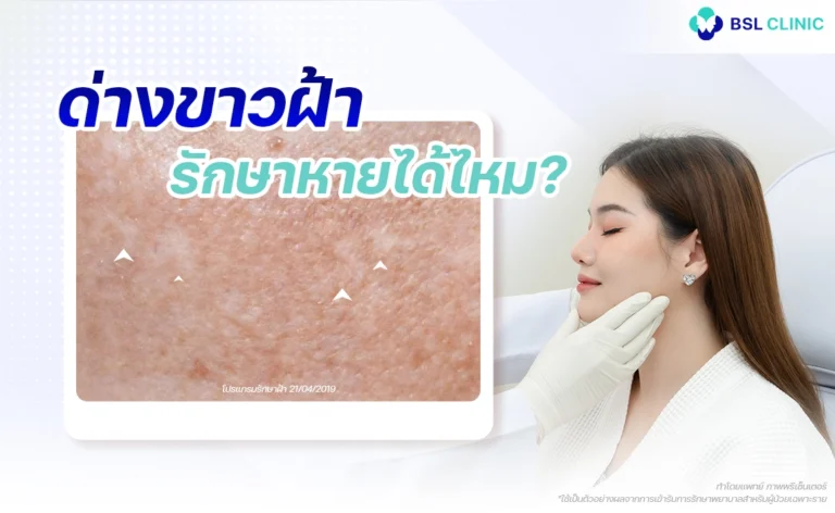 ด่างขาวฝ้า melasma laser