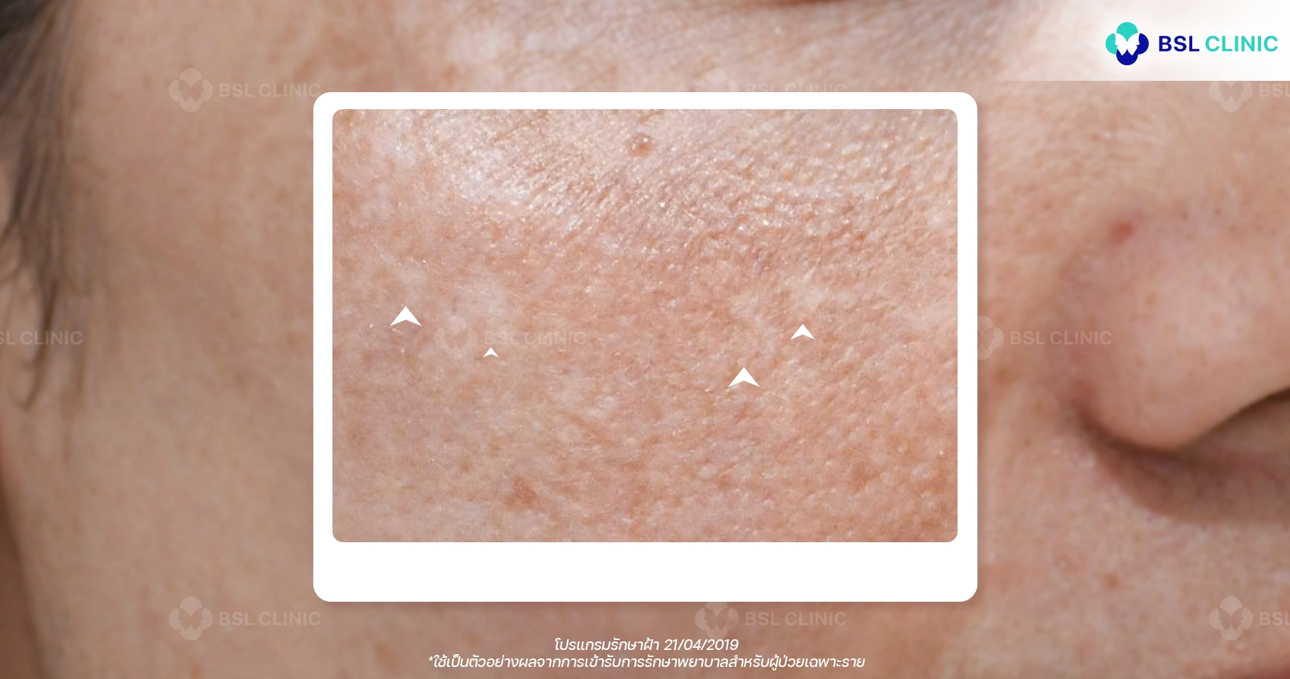 melasma laser ด่างขาวฝ้า