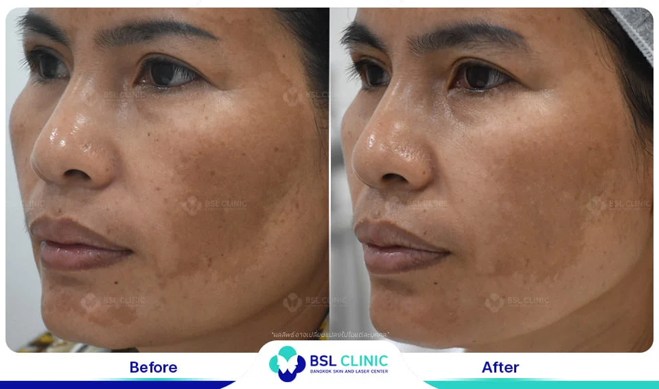 ทำงานกลางแดดจนเป็นฝ้า รักษาแบบไหนไม่ให้กลับมาเข้มขึ้น 9 before after หน้าเป็นฝ้า
