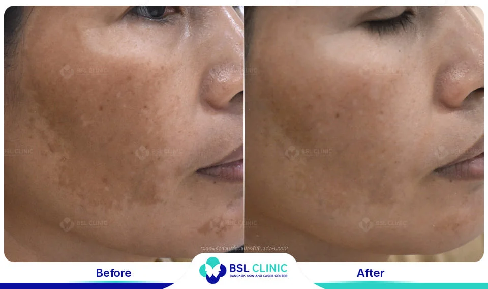 ทำงานกลางแดดจนเป็นฝ้า รักษาแบบไหนไม่ให้กลับมาเข้มขึ้น 10 before after หน้าเป็นฝ้า