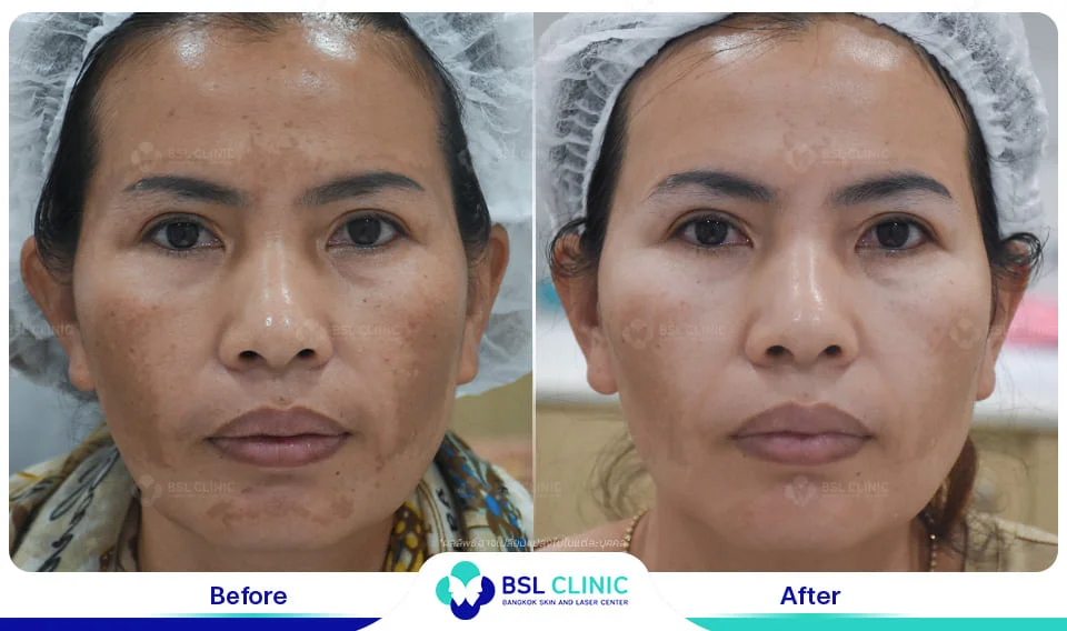 ทำงานกลางแดดจนเป็นฝ้า รักษาแบบไหนไม่ให้กลับมาเข้มขึ้น 8 before after หน้าเป็นฝ้า