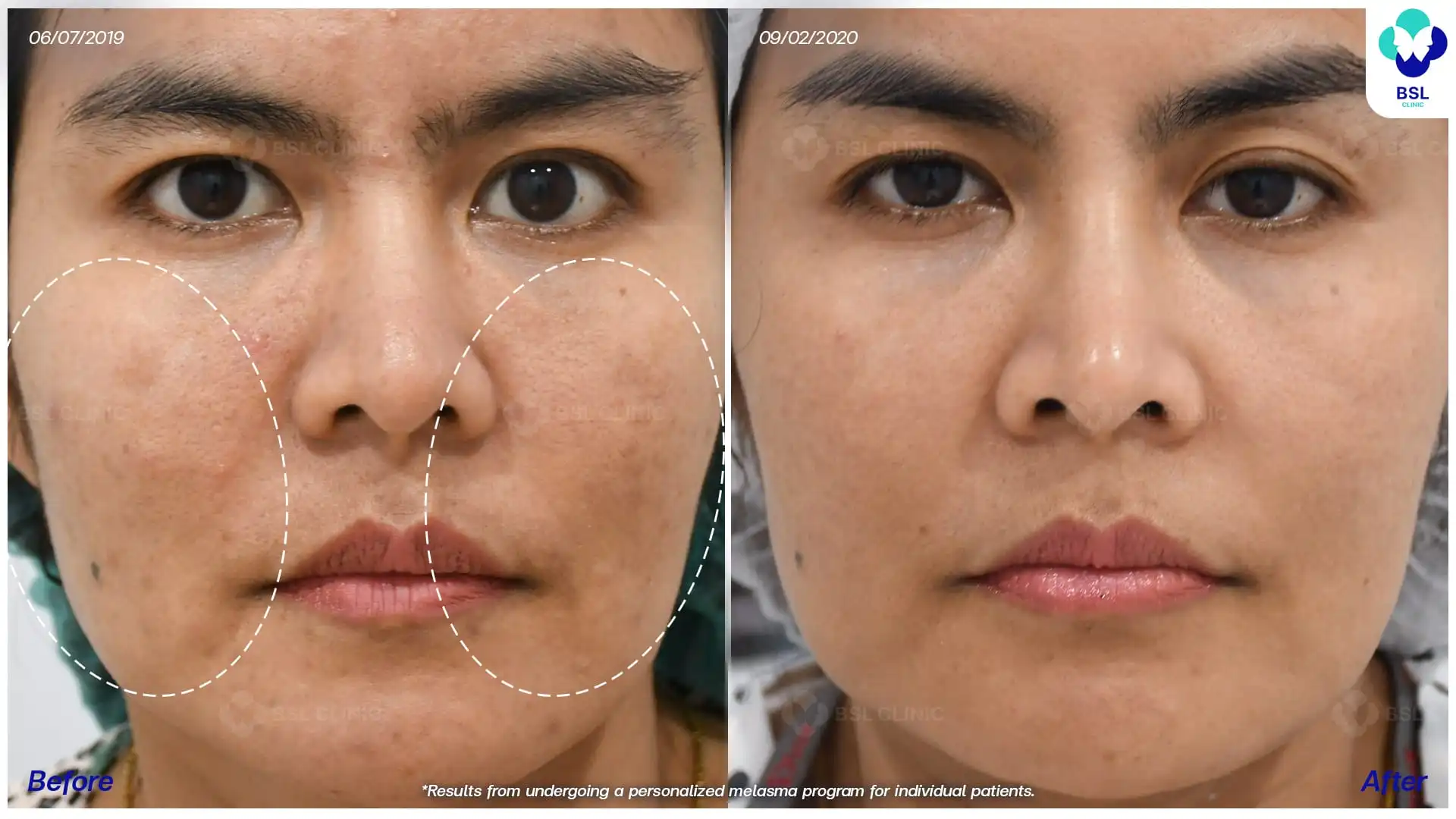 ภาพก่อน หลังการรักษาฝ้า