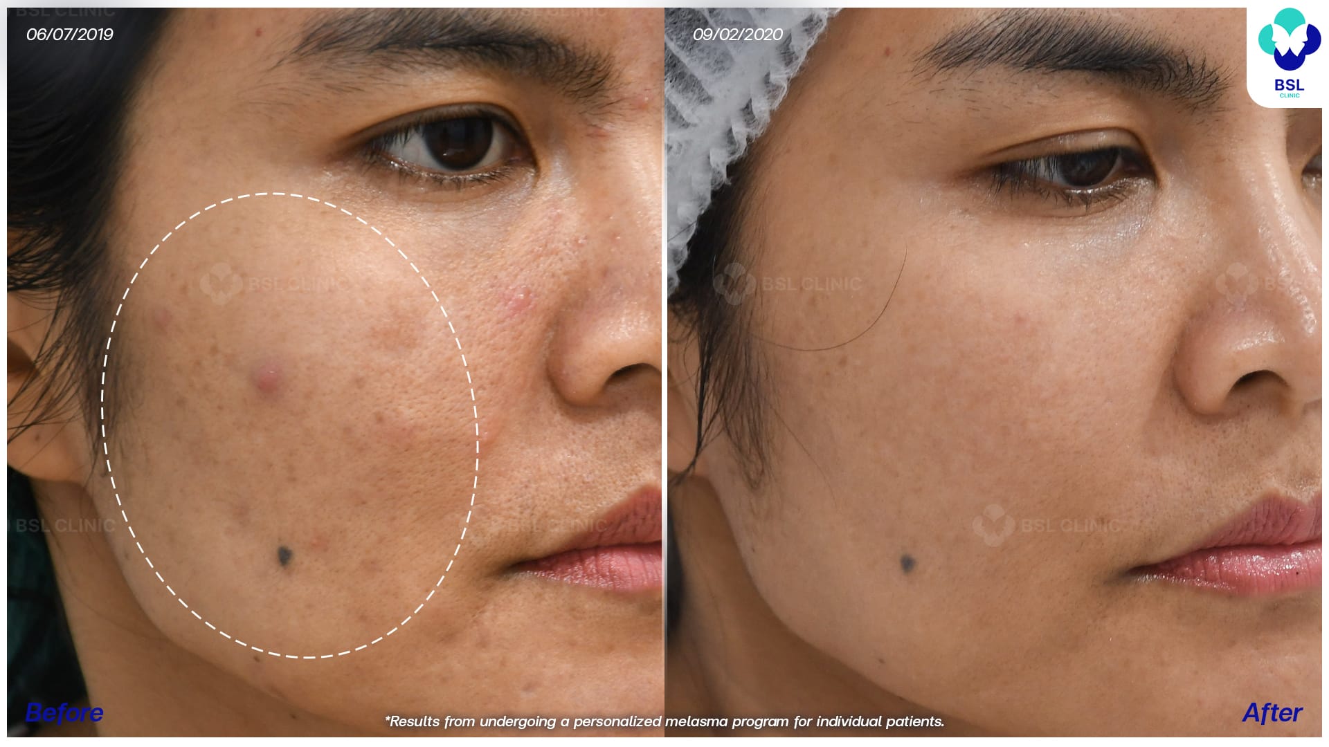 เปิดใจรีวิวรักษาฝ้า จากผู้ใช้บริการที่อยากรู้จัก BSL ให้เร็วกว่านี้ 9 ภาพก่อน-หลังการรักษาฝ้า