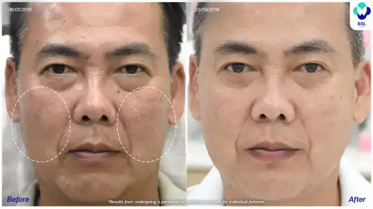 ภาพก่อน หลังรักษาฝ้า