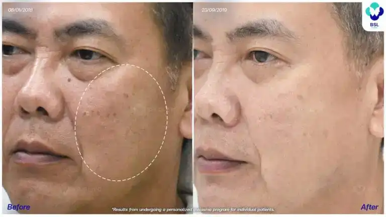 ภาพก่อน หลังรักษาฝ้า