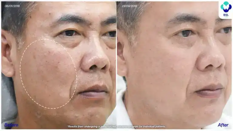 ภาพก่อน หลังรักษาฝ้า