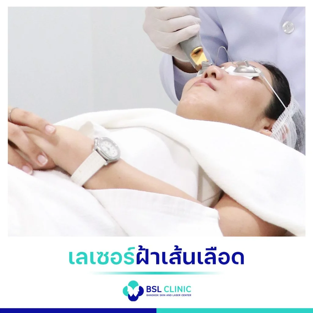 6 ขั้นตอน วิธีรักษาฝ้า เลือกแบบที่ใช่ ตรงกับปัญหาฝ้าของคุณ 4 วิธีรักษาฝ้า เลเซอร์ฝ้าเส้นเลือด