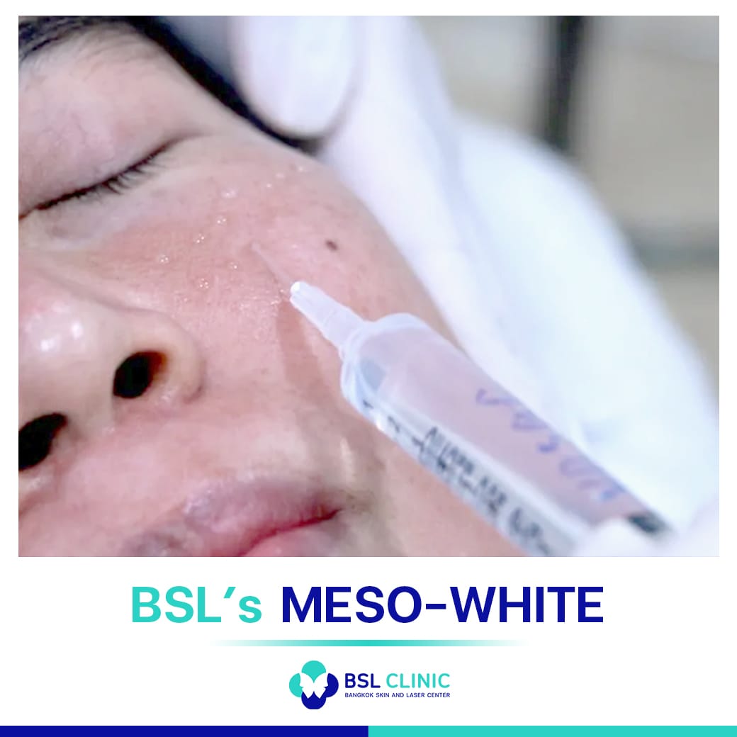 วิธีการรักษาฝ้า BSL’s MESO-WHITE