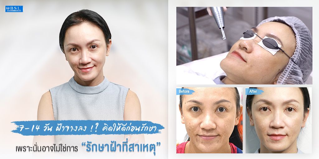 7-14 วัน ฝ้าจางลงอย่างรวดเร็ว คิดดูให้ดีก่อนรักษาฝ้า 1 ฝ้าจางลง