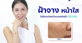 หมอรักษาฝ้า