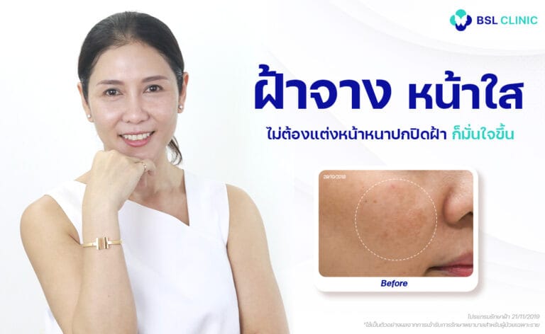 หมอรักษาฝ้า