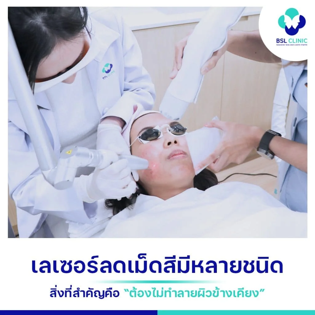 BSL Clinic เราเชี่ยวชาญในการตั้งค่าพลังงานเลเซอร์รักษาฝ้า 3 รักษาฝ้า-ด้วยเลเซอร์ลดเม็ดสี