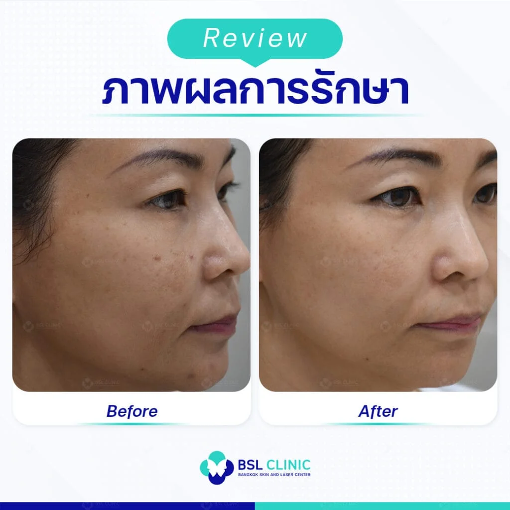 ฝ้าบนใบหน้า เป็นง่าย แต่หายไม่ยาก รักษาและป้องกันให้ถูกวิธี 3 ฝ้าบนใบหน้าเป็นง่าย