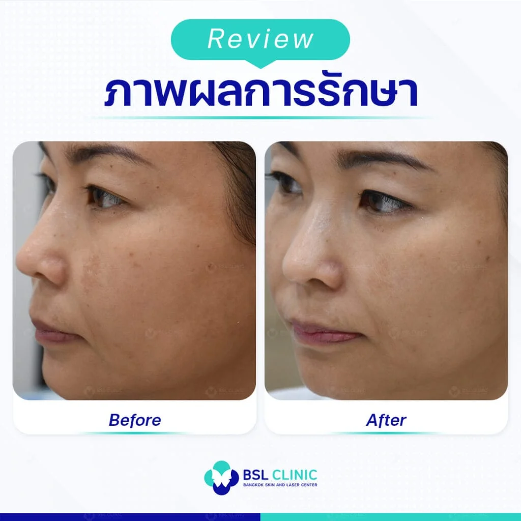 ฝ้าบนใบหน้า เป็นง่าย แต่หายไม่ยาก รักษาและป้องกันให้ถูกวิธี 2 ฝ้าบนใบหน้าเป็นง่าย
