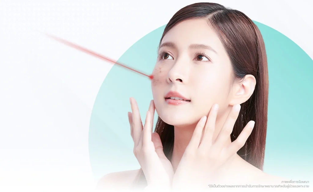 pico laser melasma pico ฝ้าคนไทย พลังงานเสถียรเสมอกัน