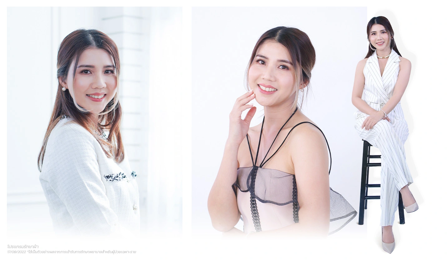 the-passion-คนไข้-รักษาฝ้า-คุณมาลิน