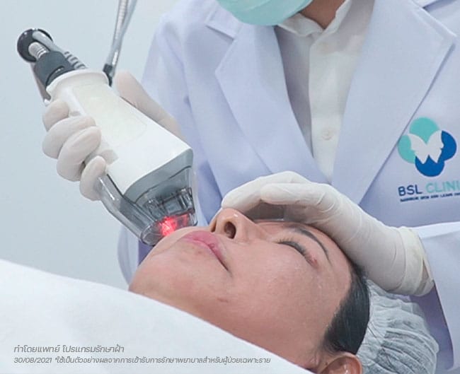 รีวิวรักษาฝ้า ถ้ารู้จัก BSL Clinic ตั้งแต่แรก ก็คงดี 10 เลเซอร์ฝ้า-ดึงเม็ดสีออก