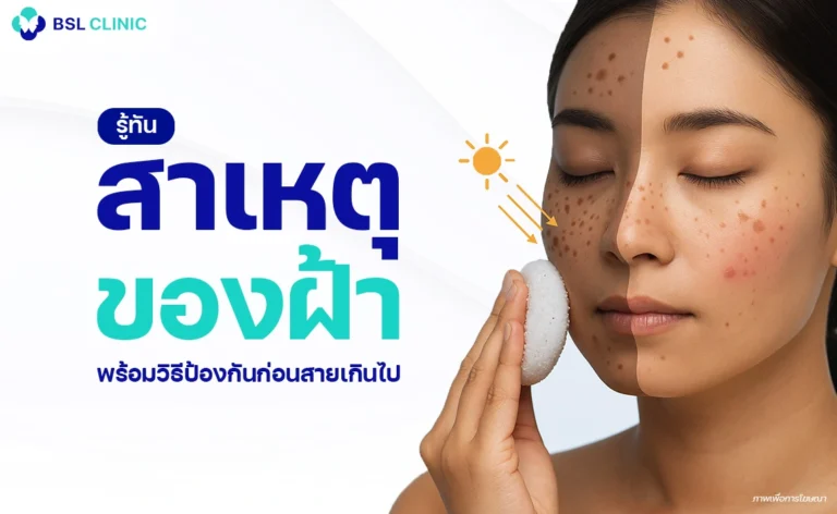 สาเหตุของฝ้า