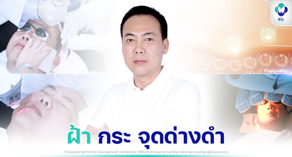 รีวิวรักษาฝ้า คุณพีระ