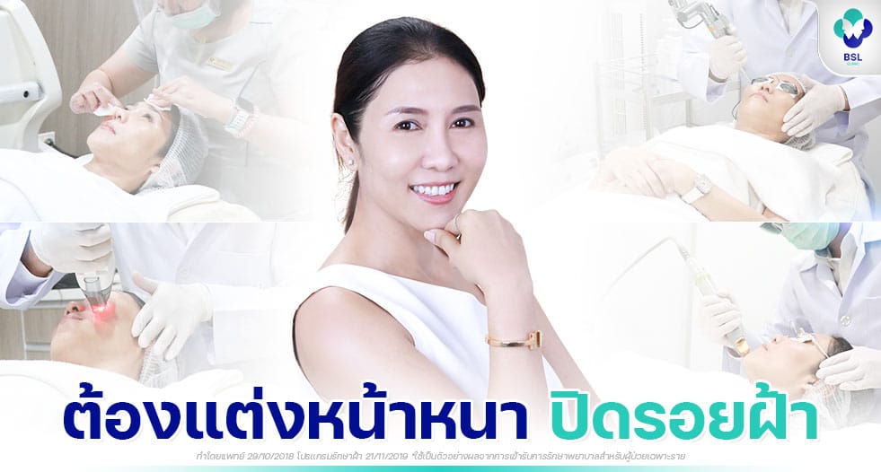 ปิดรอยฝ้า