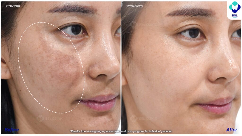 Landing Page Melasma 15 รีวิวรักษาฝ้า