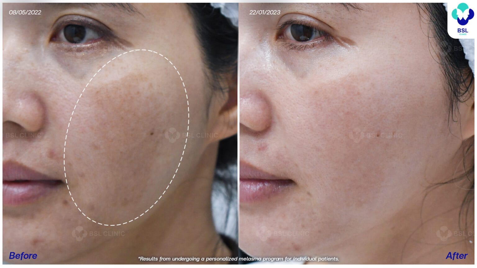 Landing Page Melasma 16 รักษาฝ้า
