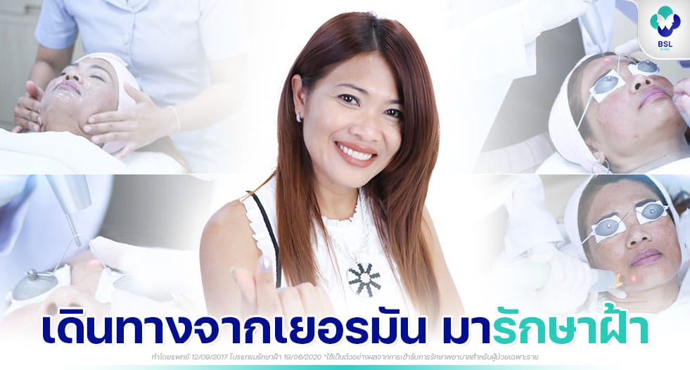 ยืนหนึ่งเรื่องรักษาฝ้า เห็นผลจริง