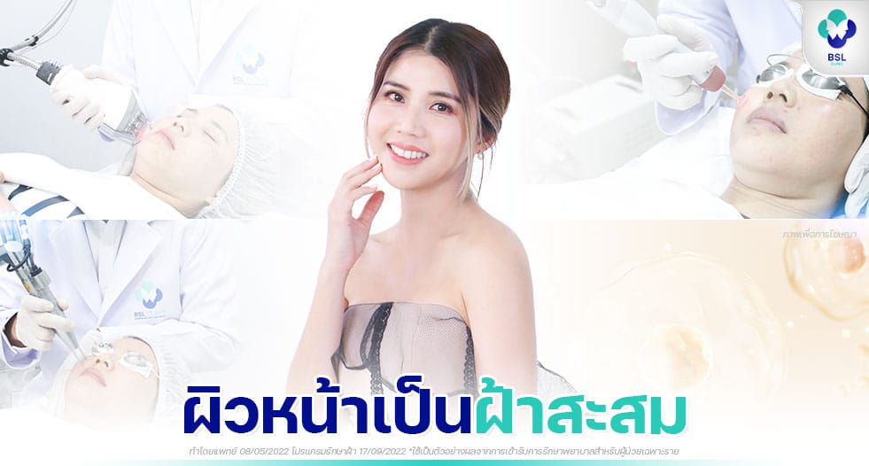 รักษาฝ้า