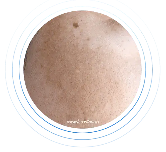 melasma ฝ้า สาเหตุการเกิด 1