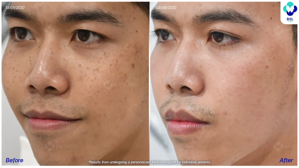 ผลการรักษากระ กระตื้น กระลึก