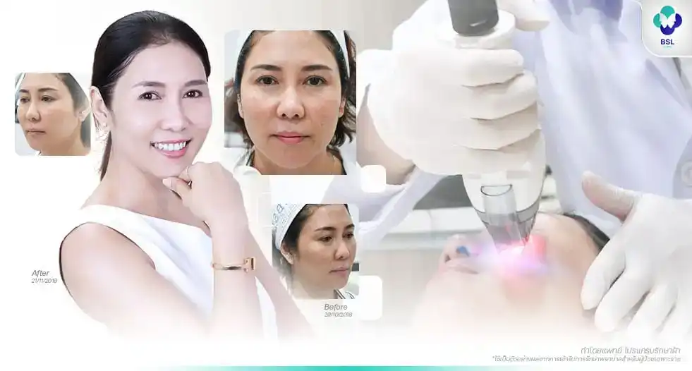 แต่งหน้า ปกปิดฝ้า